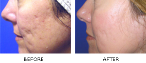 reliant-fraxel-acne