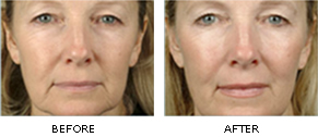 treatment Facial thermage